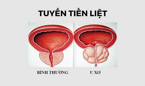 u xơ tuyến tiền liệt